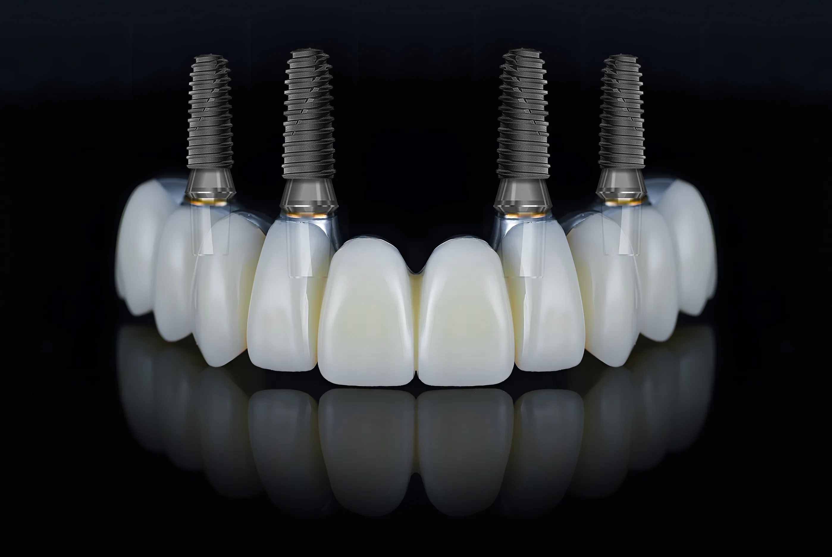 All-on-X Implants