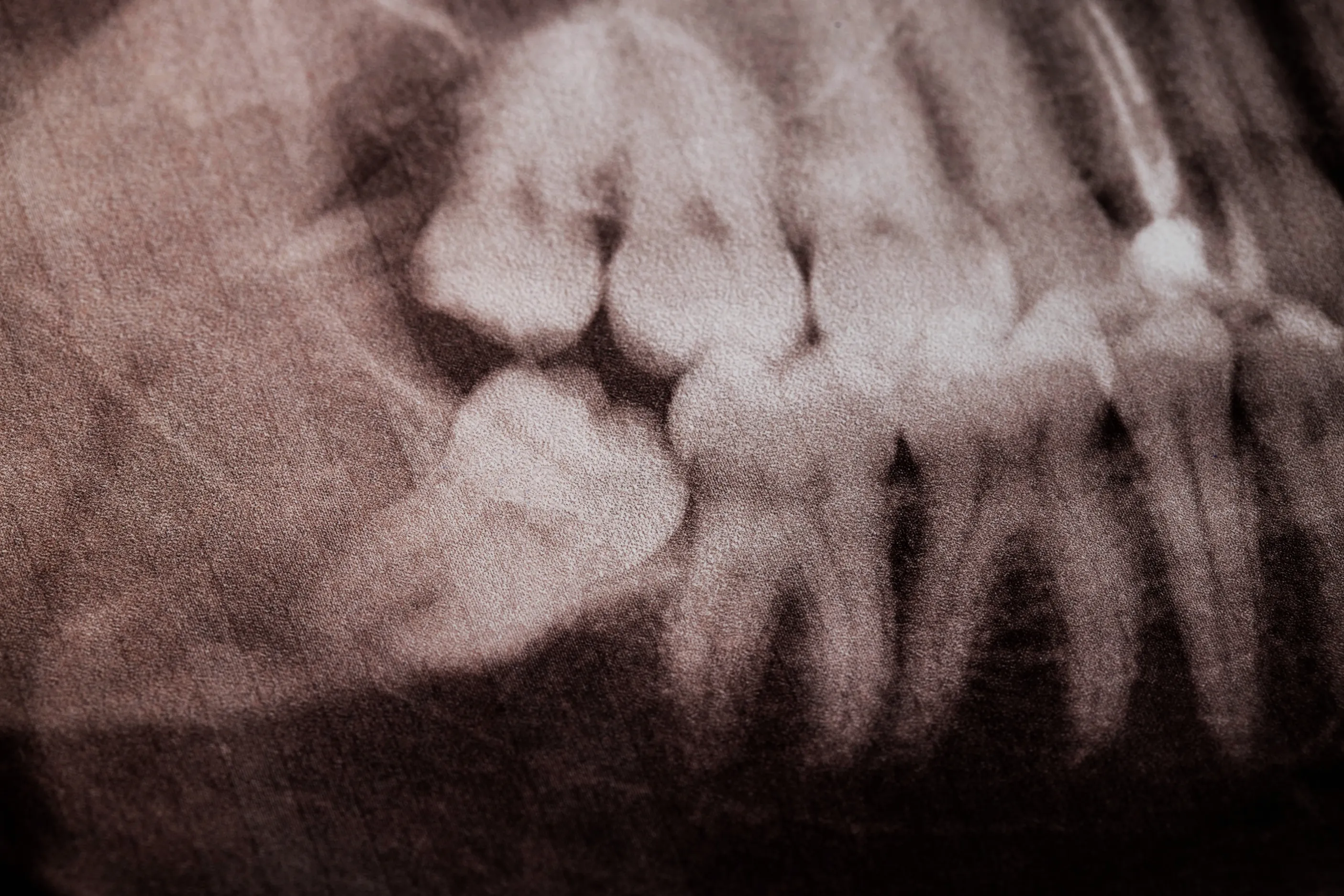 Wisdom Teeth Removal